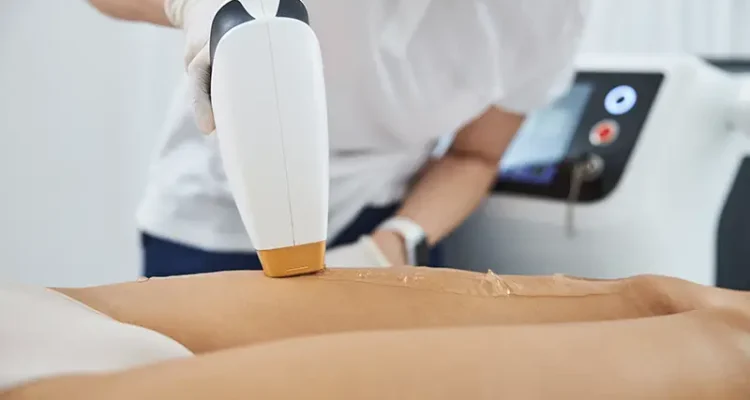depilacion_laser